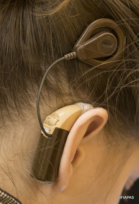 Imagen de una joven con un implante coclear (c) FIAPAS
