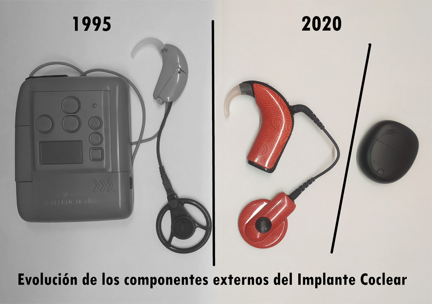 Implante coclear antiguo y nuevo
